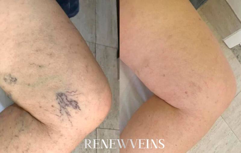 dep2_edit_renewveins-1024x649